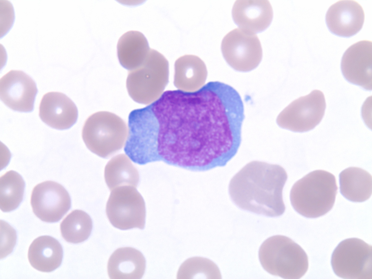 Progression to AML 1000x